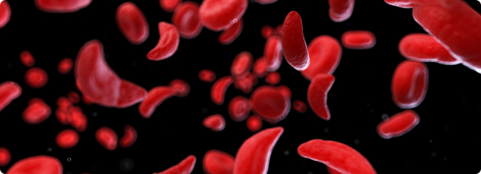 Image of Sickle Cell