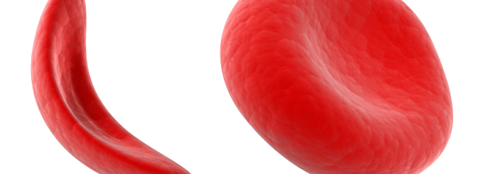 A sickle cell and a normal blood cell