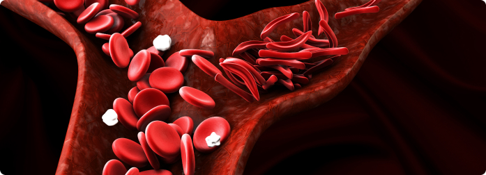 A cheek rash is common symptom of sickle cell disease
