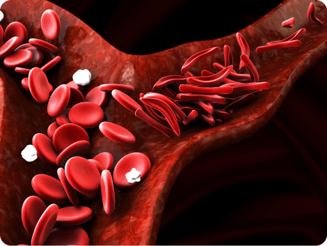 Sickle Cell