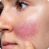 A woman with a red cheek